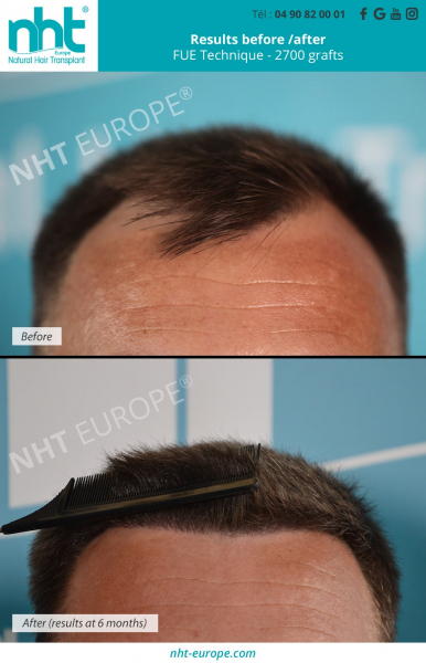 2700 grafts transplant fue dhi technique before after results