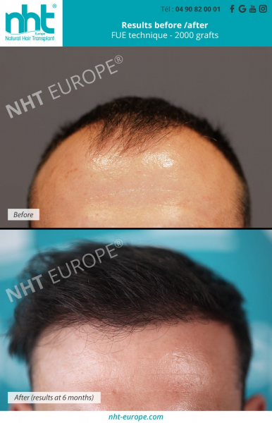 Hair transplant-2000-transplant-result-before-after-technique-fue -centre-nht-front-hair-line-hair-graft-grafting-hair-loss