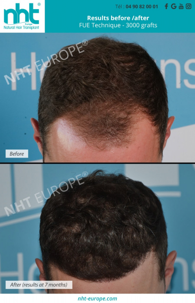 3000 grafts hairtransplant before after results at 7 months