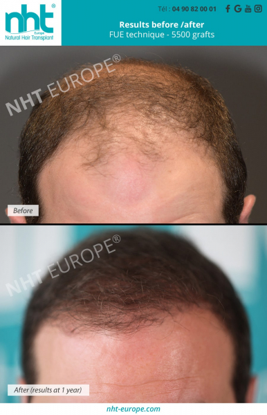 Hair-transplant-vertex-frontal-hair-line-before-after-results-5500-grafts-man-hair-density-alopecia-baldness-bald-spot