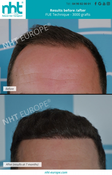 3000 grafts hairtransplant before after results at 7 months