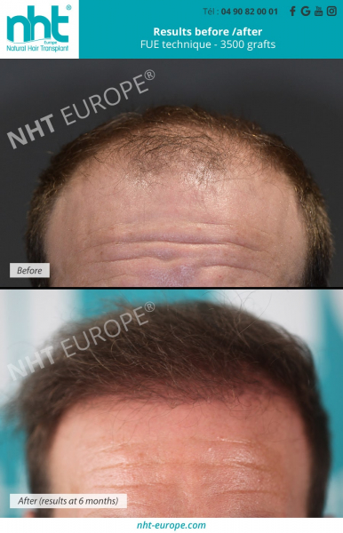 Hairtransplant-transplantation-3500-graft-technique-fue-result-before-after-densification-golfes-fronto-temporal-line-vertex-summit-crane-nht-europe-avignon