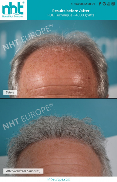 before after results hair transplant 4000 grafts at 6 months