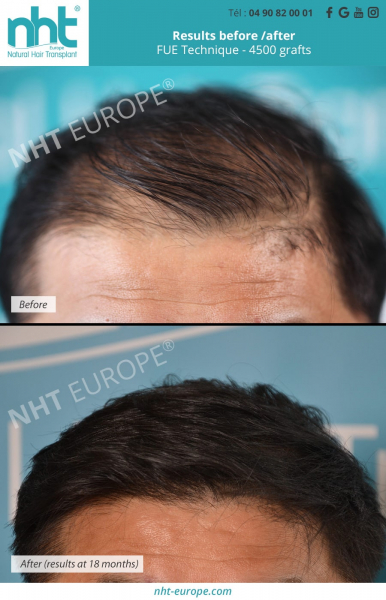 4500 grafts hairtransplant frontal hairline