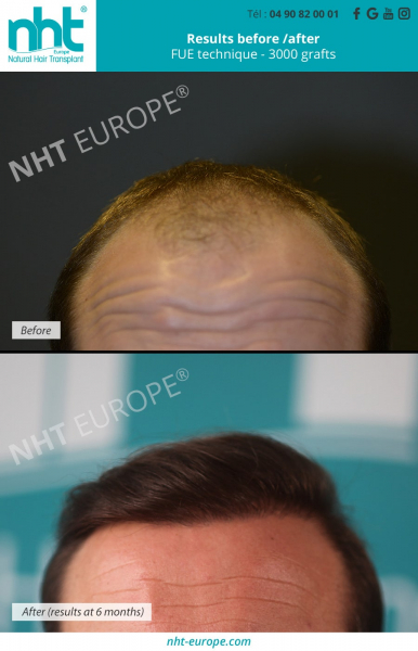 hair-transplantation-results-before-after-at-6-months-fue-technique-3000-grafts-alopecia-bald-men-man-hair-line-densification-baldness-solution-thick-hair