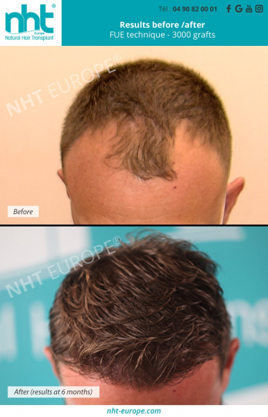 hair-transplant-results-before-after-at-6-months-fue-technique-3000-grafts-alopecia-bald-men-man-hair-line-densification-baldness-solution