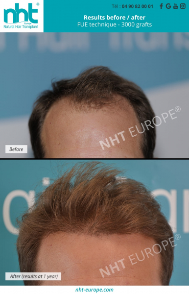 results-before-after-3000-grafts-at-1-years-fue-dhi-methode-hairgrowth-nht-europe-centre-in-france-frontal-area