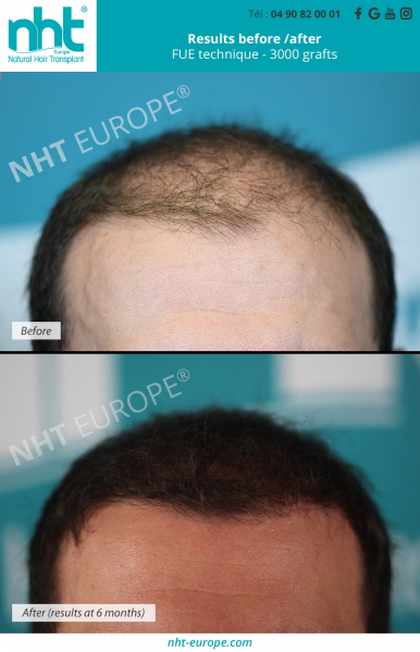 Hair-grafting-before-after-frontline-3000-technical-grafting-fue-centre-nht-europe-avignon-vaucluse-south-of-France-baldness-alopecia-bald-spot-hair-loss