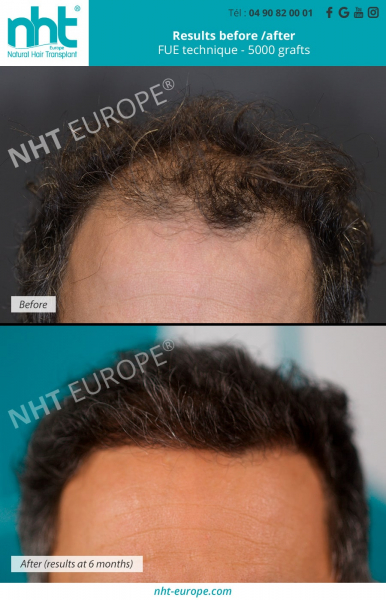 Hair transplantation-implantation-results-after-6-months-5000-graft-technique-fue-doctor-ginouves-density-hair-thickness-centre-nht-europe-avignon-vaucluse-baldness-calopecia-hairloss-bald-spot