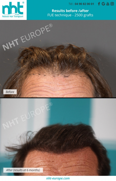 Hair transplant-2500-transplant-result-before-after-technique-fue -centre-nht-front-hair-line-hair-graft-grafting-hair-loss