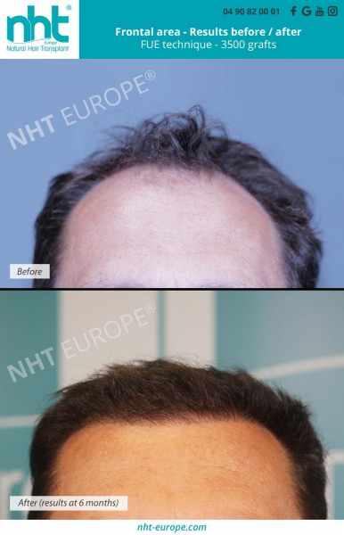 3500-hairgraft-results-before-after-6-months-fue-technique