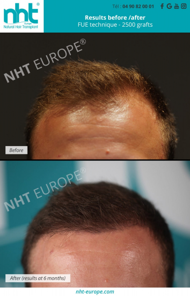 Hair-grafting-before-after-frontline-2500-technical-grafting-fue-centre-nht-europe-avignon-vaucluse-south-of-France-baldness-alopecia-bald-spot-hair-loss