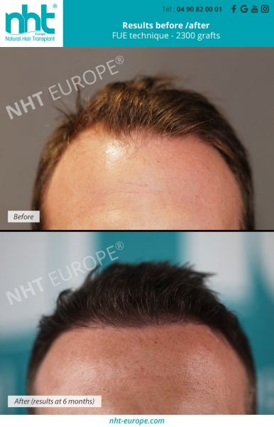 Hair transplantation-implantation-results-after-6-months-2300-graft-technique-fue-doctor-ginouves-density-hair-thickness-centre-nht-europe-avignon-vaucluse-baldness-calopecia-hairloss-bald-spot