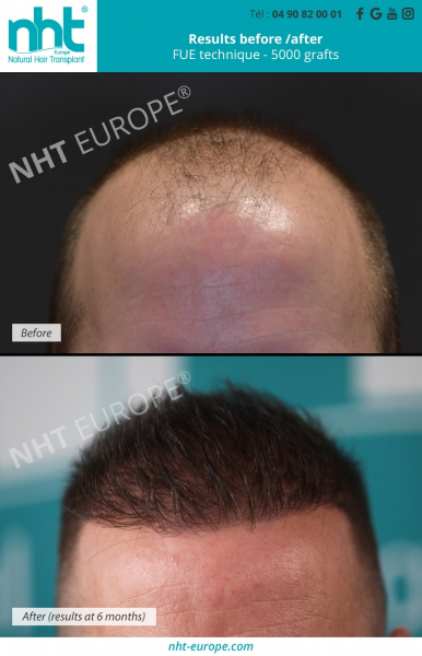 Hair-transplant-results-before-after-fue-technique-5000-grafts-6-months-post-op-baldness-bald-spot-alopecia-hair-loss-men-man