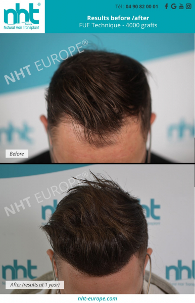 4000-grafts-hairtransplant-before-after-results-man