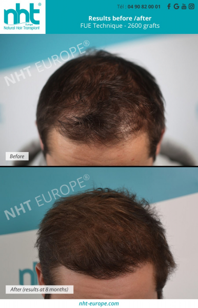 2600-hair-grafts-hair-transplantation-fue-dhi-technique-before-after-results-at-8-months