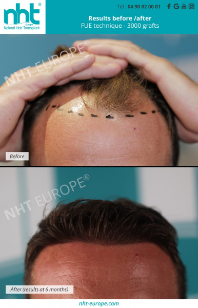 hair-transplant-3000-temporal-grafts-frontline-front-result-before-6-months-growth-france