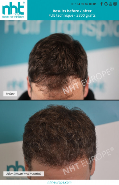 6-months-post-operative-hair-transplant-of-2800-hair-grafts-results-before-after-hair-grow-thicker