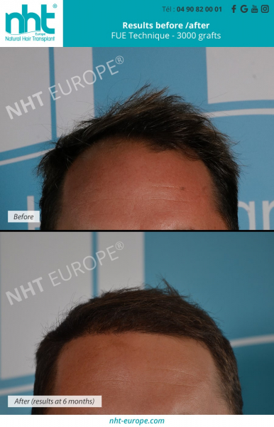 results before after hair transplant 3000 grafts at 6 months