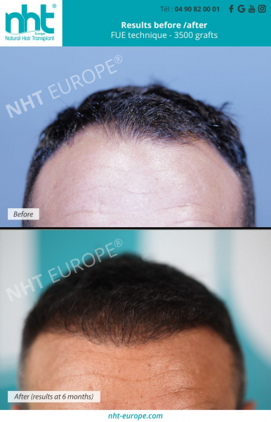 Hair-grafting-before-after-frontline-3500-technical-grafting-fue-centre-nht-europe-avignon-vaucluse-south-of-France-baldness-alopecia-bald-spot-hair-loss-men-man
