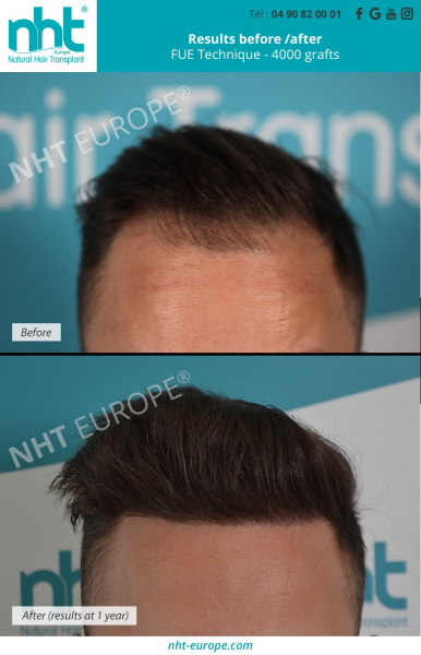 before-after-result-hair-transplant-4000-grafts-man
