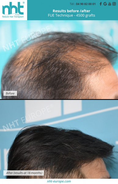hairgrafting 4500 grafts 18 months post operative