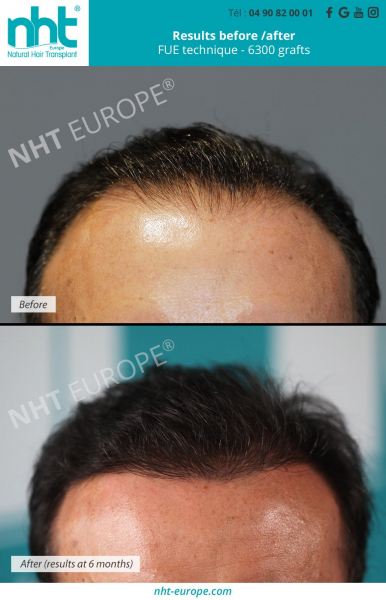 results-before-after-6300-grafts-hair-transplant-transplantation-fue-technique-at-2-years-france-avignon-hair-men-man-hairloss-solution-baldndess-frontline-hair-line-density-thick-hair-bald-long-hair-nht-europe