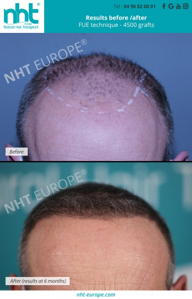 hair-transplant-results-before-after-at-6-months-fue-technique-4500-grafts-alopecia-bald-men-man-hair-line-densification-baldness-solution-thick-hair-forhead-top-pf-the-head-growth-hair