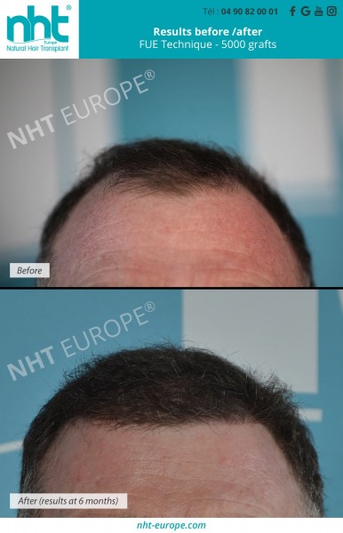 5000 grafts hair transplant before after results at 6 months