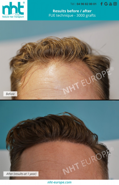 fhair-transplant-results-before-after-at-1-year-fue-dhi-technique-3000-grafts-alopecia-bald-men-man-hair-line-densification-baldness-solution-hairgrow
