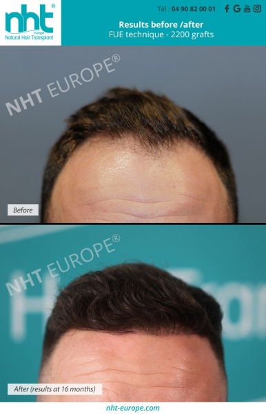 men-hair-transplant-before-after-results-fue-technique-2200-grafts-at-16-months-baldness-and-hair-loss-solution-frontal-area-south-of-france-avignon-aloepecia