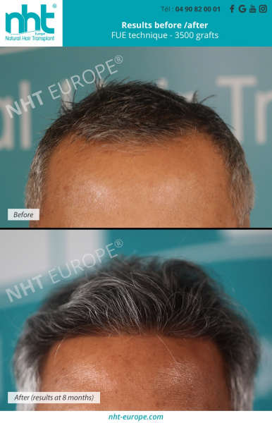 men-hair-transplant-on-grey-hair-before-after-results-fue-technique-3500-grafts-at-8-months-frontal-area-density-hairloss-solution-alopecia