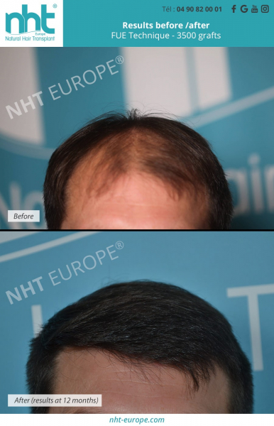 1 year result hairtransplant 3500 grafts nht europe
