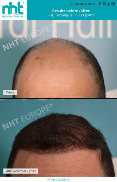 hair-transplant-hairline-top-of-the-head-fue-dhi-technique-6000-grafts-results-before-after-1-year-hair-growth-solution-alopecie