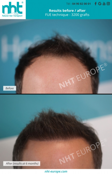 Photo showing the results of a hair transplant 6 months after surgery with 3200 grafts