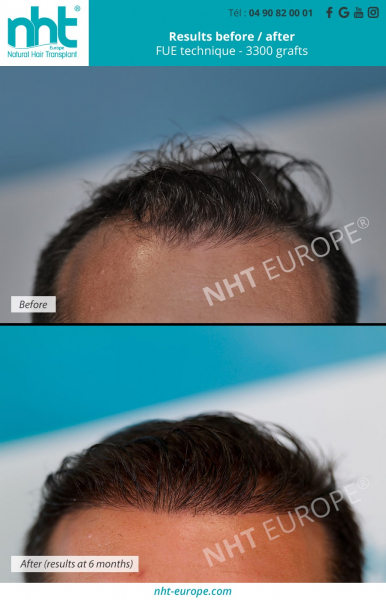 Photo showing the results of a hair transplant 6 months after surgery with 3300 grafts