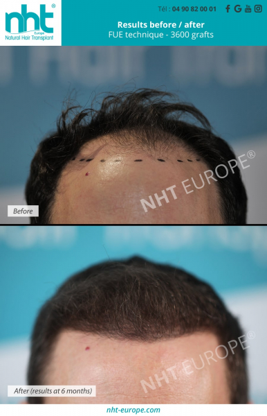 Photo showing the before and after of a hair transplant on a 6 months timelapse after surgery with 3600 grafts