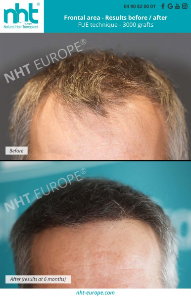 6-months-post-operative-frontal-area-hairgrafting-before-after-results-3000-grafts