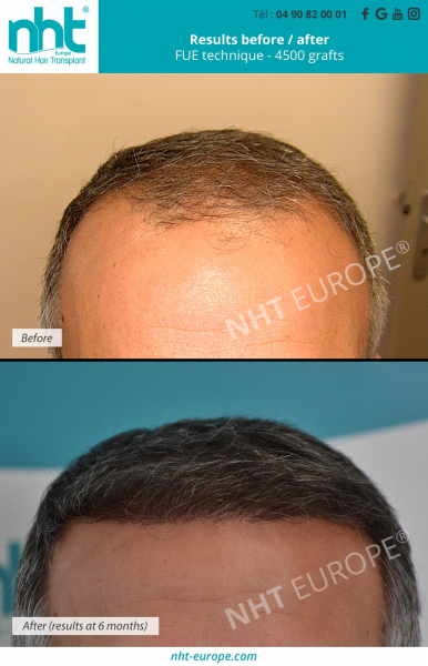 results-before-after-4500-grafts-fue-dhi-technique-at-6-months-hairgrowth-center-nht-in-france-avignon