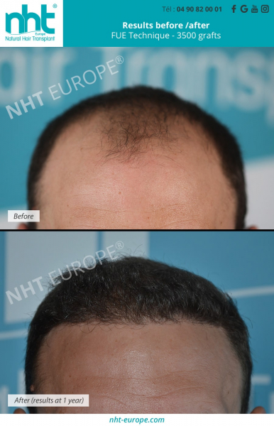 hairtransplant 3500 grafts fue technique 1 year post operatiive