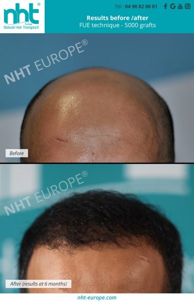 hair-transplantation-hair-grafting-on-bald-head-fue-technique-5000-grafts-results-before-after-at-6-months-top-of-the-head-hair-growth-NHT-center-france-clinic