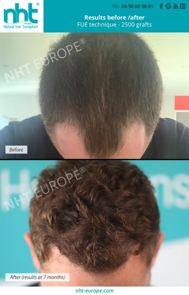 young-man-hair-transplant-fue-technique-fronto-temporal-gulfs-france-2500-grafts-results-before-after-at-7-months-with-curly-hair-hair-growth-hairloss-solution-frontal-area