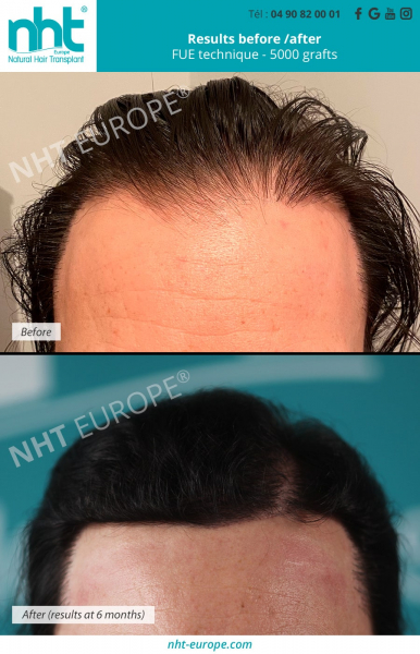 hair-transplant-fue-technique-5000-grafts-frontal-area-results-before-after-at-6-months-hair-densification-hair-growth