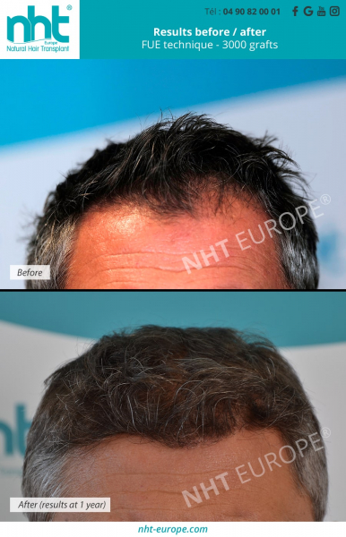 frontal-area-hair-transplant-results-before-after-3000-grafts-fue-dhi-technique-nht-centre-in-france-best-hair-clinic-hairgrowth-baldness-solution-alopecia