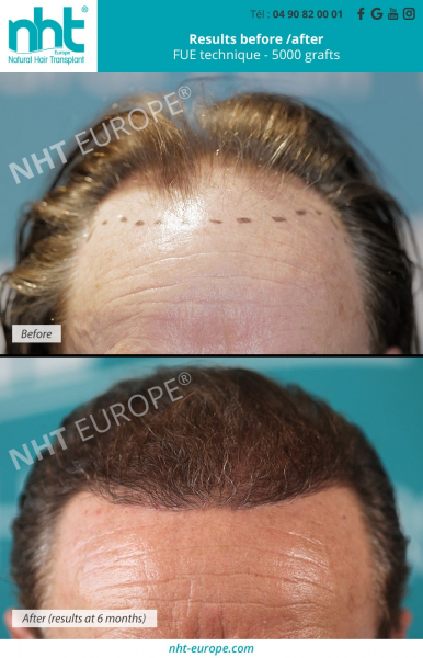 Hair-grafting-before-after-frontline-5000-technical-grafting-fue-centre-nht-europe-avignon-vaucluse-south-of-France-baldness-alopecia-bald-spot-hair-loss
