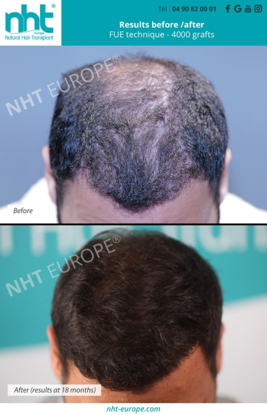 men-hair-transplant-hair-grafting-before-after-results-fue-technique-4000-grafts-at-6-months-baldness-and-hair-loss-solution-frontal-area-south-of-france-avignon-aloepecia-photos-pictures