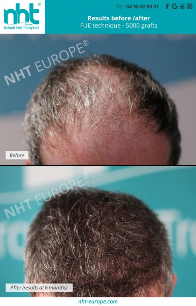 men-hair-transplant-hair-grafting-before-after-results-fue-technique-5000-grafts-at-6-months-baldness-and-hair-loss-solution-frontal-area-south-of-france-avignon-aloepecia