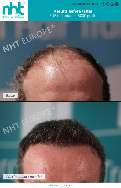 before-after-results-hair-transplant-6-months-post-operative-frontal-area-5000-grafts-hairloss-baldness-alopecia-hair