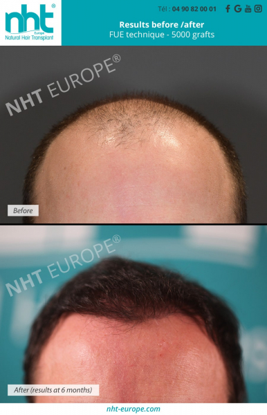 hair-transplant-of-5000-grafts-on-the-frontline-before-skull-result-a-6-months-clinic-capillary-avignon-south-of-France-baldness-solution