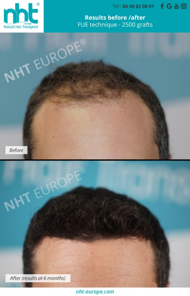hair-grafting-result-before-after-2500-greffons-fue-dhi-summit-clinic-nht-europe-avignon-best-hair-clinic